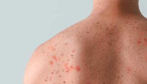 Guatemala refuerza vigilancia epidemiológica contra el sarampión