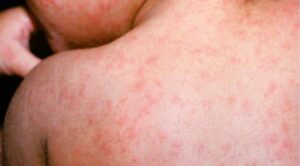 Guatemala: brote de sarampión suma 868 casos hasta marzo