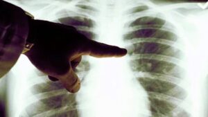 ¿Qué es la peste pulmonar y por qué genera alerta el caso de Rusia?